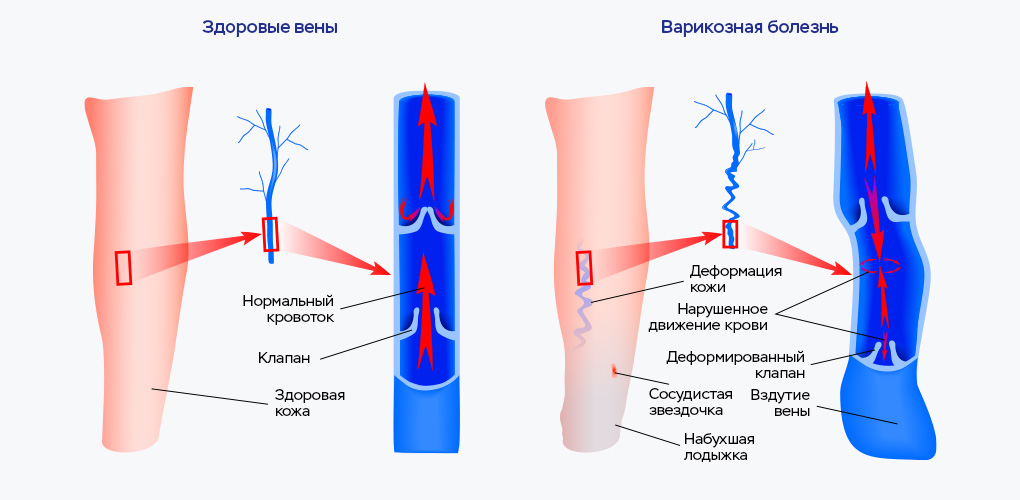 Восстановление сосудов пептидами варикоз. Картинка.